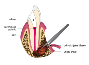 Resekcija korena zuba (apikotomija)