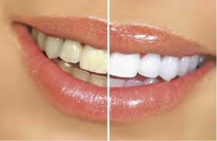 Tooth whitening