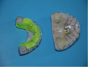 Funkcionalni ortodontski aparati-Monoblok i Tvinblok1